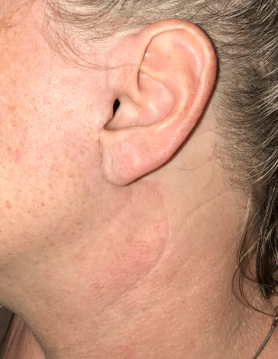oreille chirurgie parotide Parotidéctomie Bruxelles