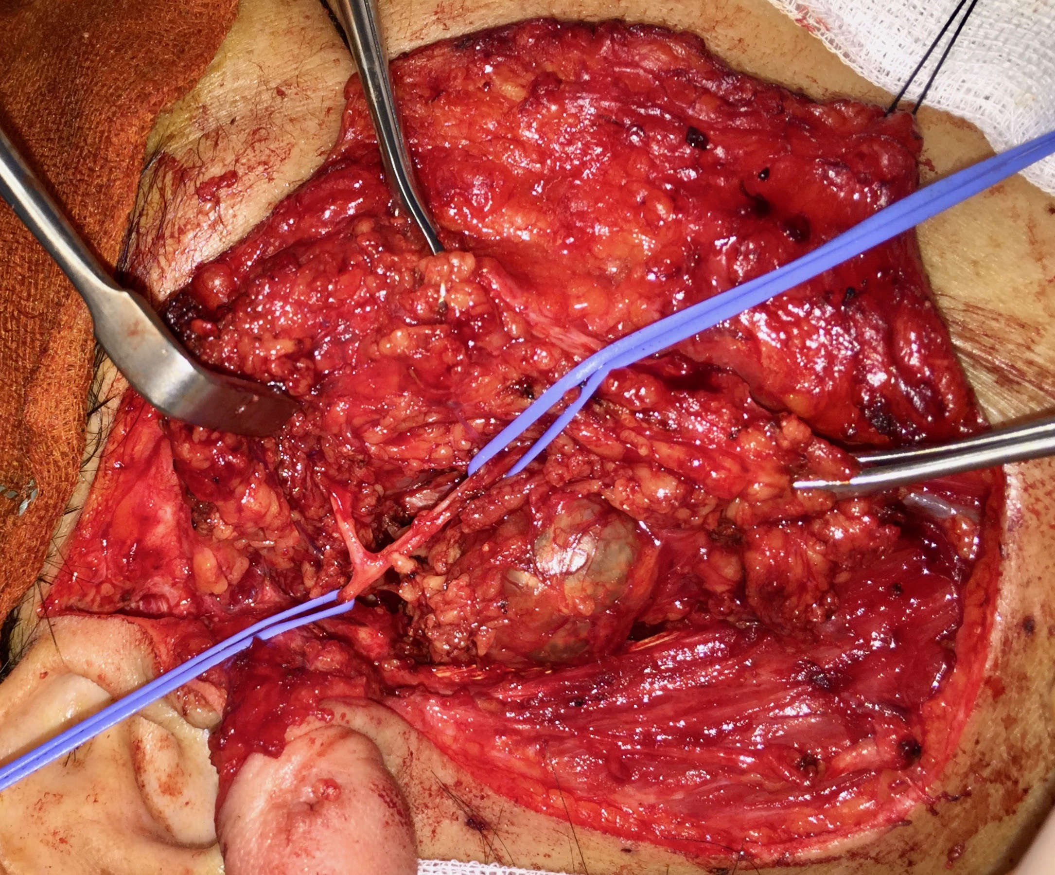 Separation tumeur chirurgie parotide Parotidéctomie Bruxelles